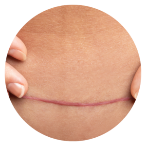C-section scar pelvic prescription
